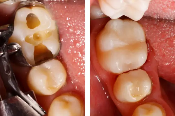 dental filling before and after image