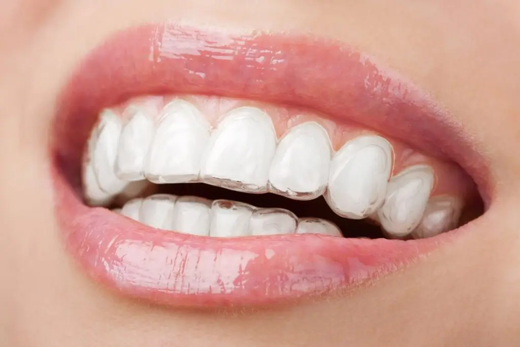 girl smiling showing her teeth having invisalign