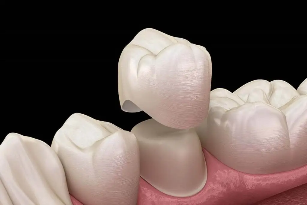 dental crowns