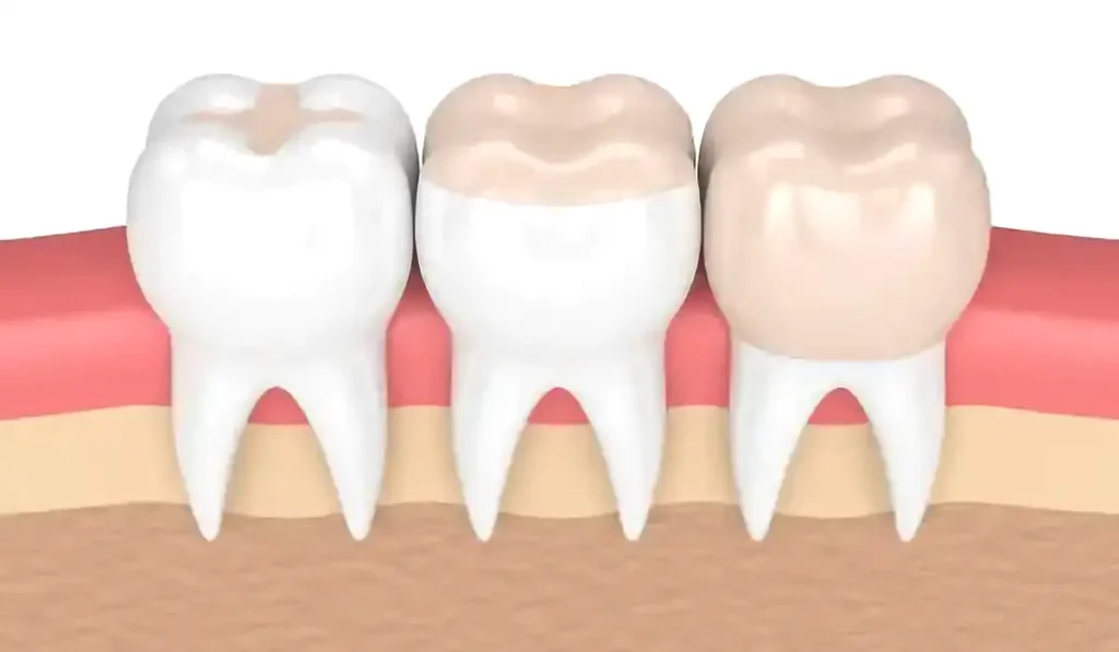 Dental Sealants and Filling shown