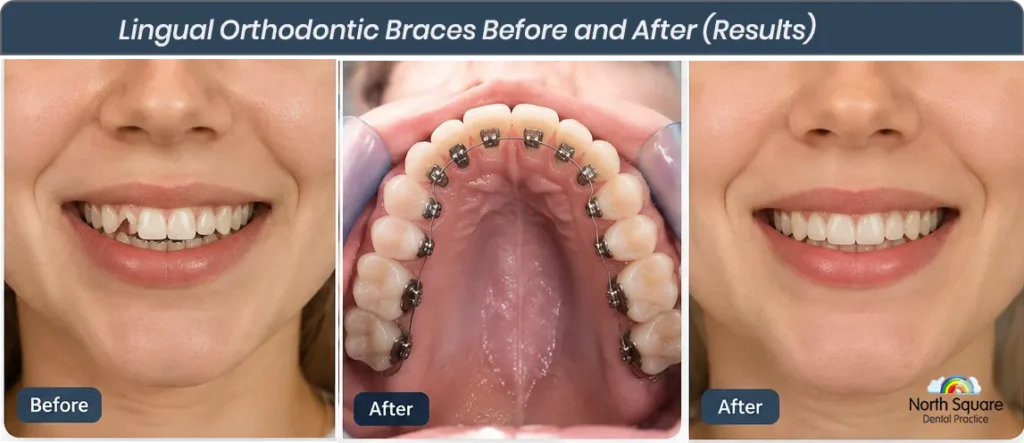 female Lingual Orthodontic Braces result