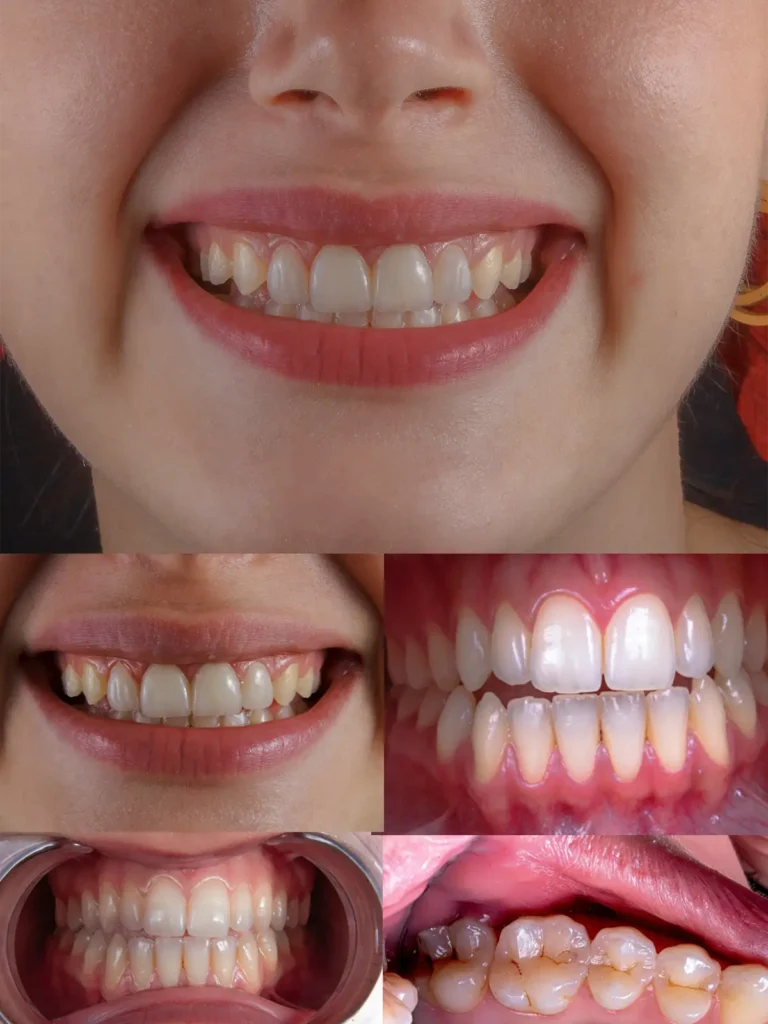 multiple images shows how gradually plaque builds up due to not brushing teeth