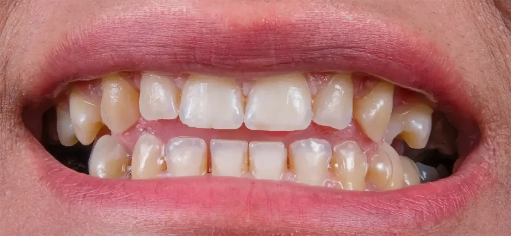 showing yellow stains caused by vaping